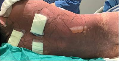 Case Report: Multi-targeted therapy in the treatment of severe toxic epidermal necrolysis